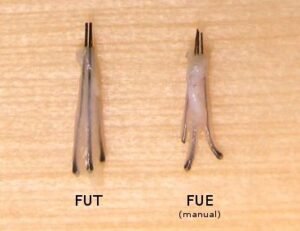 Comparação de enxertos capilares FUT e FUE