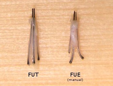 Comparação de enxertos capilares FUT e FUE