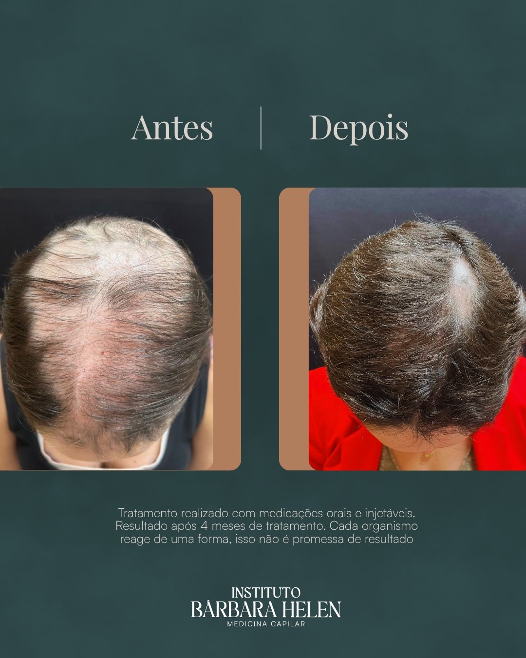 Resultado de tratamento capilar — antes e depois, com descrição do quadro — Instituto Bárbara Helen