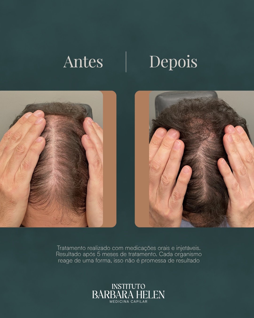 Resultado de tratamento capilar — antes e depois, com descrição do quadro — Instituto Bárbara Helen