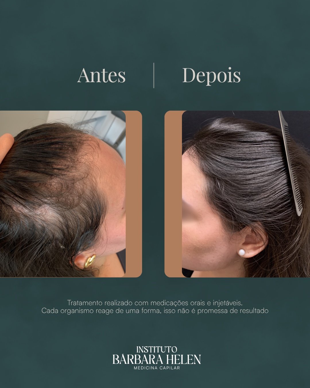 Resultado de tratamento capilar — antes e depois, com descrição do quadro — Instituto Bárbara Helen