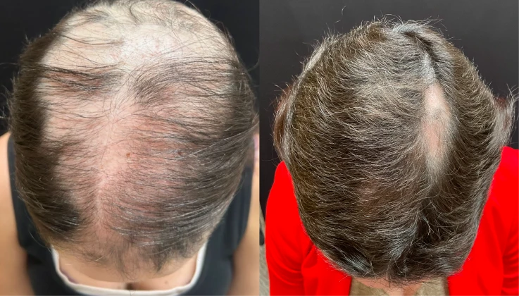 Tratamento realizado com medicações orais e injetáveis. Resultado após 4 meses de tratamento. Cada organismo reage de uma forma, isso não é promessa de resultado