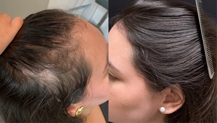 Tratamento realizado com medicações orais e injetáveis. Resultado após 5 meses de tratamento. Cada organismo reage de uma forma, isso não é promessa de resultado